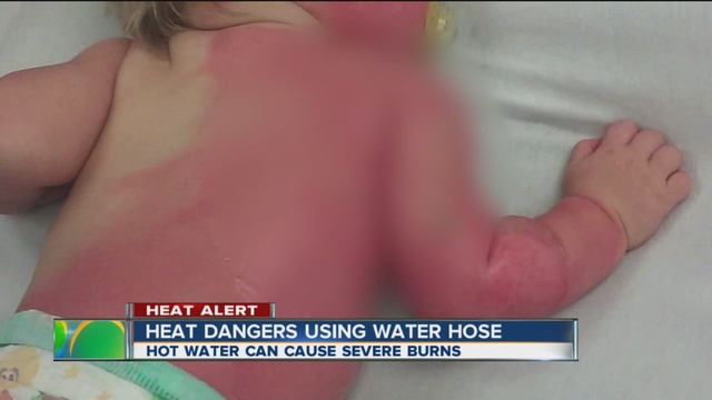 A local doctor says water that's above 100 degrees can ...